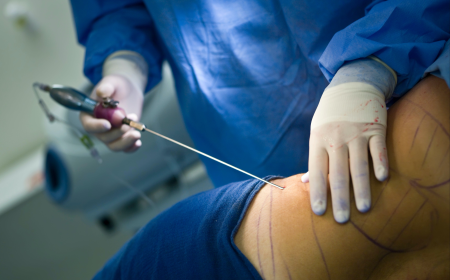 Liposuction for Men What Every Male Patient Should Know