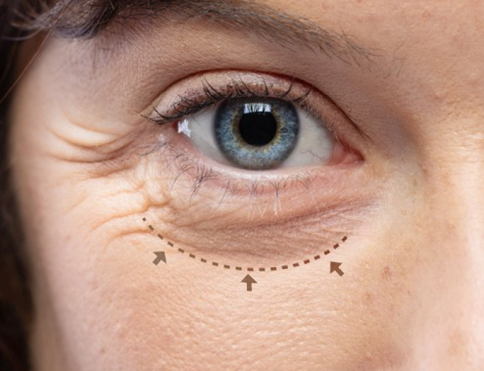 Blepharoplasty Dubai: Upper vs Lower Eyelid Surgery Explained