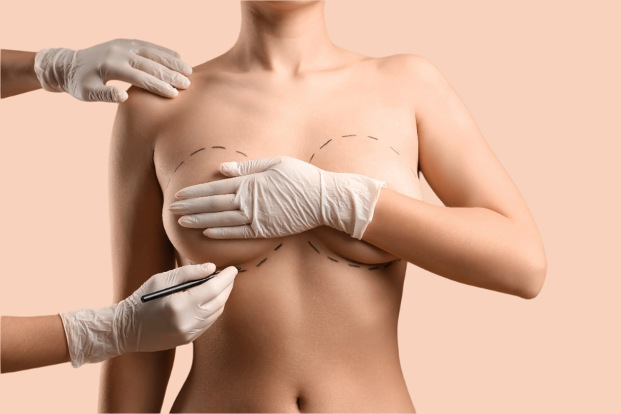 Mia Breast Implant In Dubai: Modern Breast Enhancement with Faster Recovery