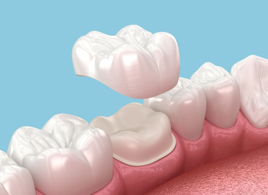 Choosing the Best Dentist for Dental Crown Dubai