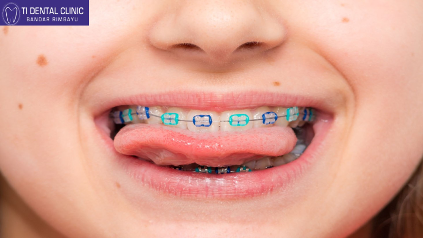 Selangor Orthodontic Cost Guide: Private vs. Public Options, Factors, and Payment Frameworks