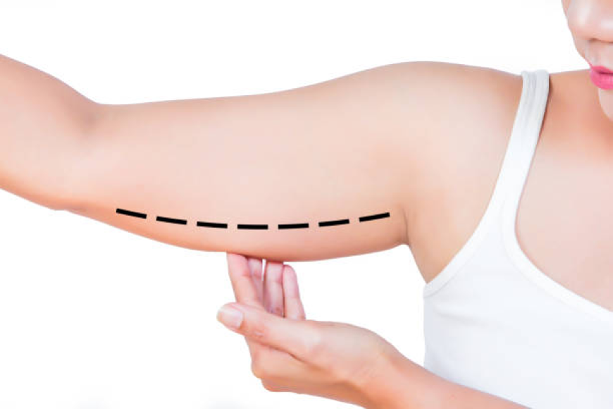 Best Arm Lift Surgery in Dubai for Firmer Upper Arms