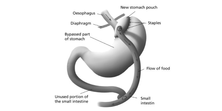 How Much Weight Can You Lose After Gastric Bypass?