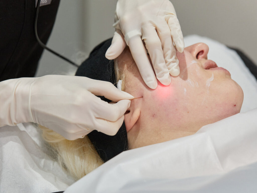 Endolift in London: Complete Guide to Laser Skin Tightening