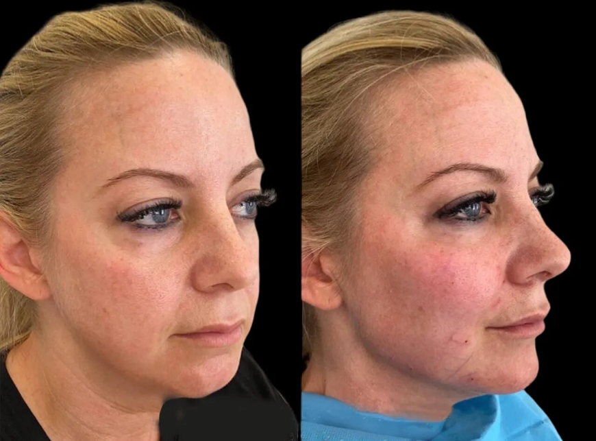 Why Doctor Skill Matters in Cheek Fillers in Dubai