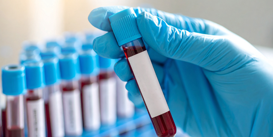 VDRL Test Price: Cost, Purpose, Procedure, Preparation & Benefits