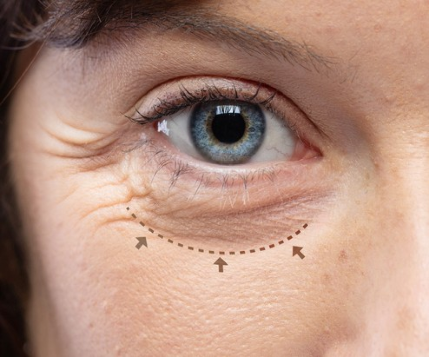 Blepharoplasty Dubai: Upper vs Lower Eyelid Surgery Explained