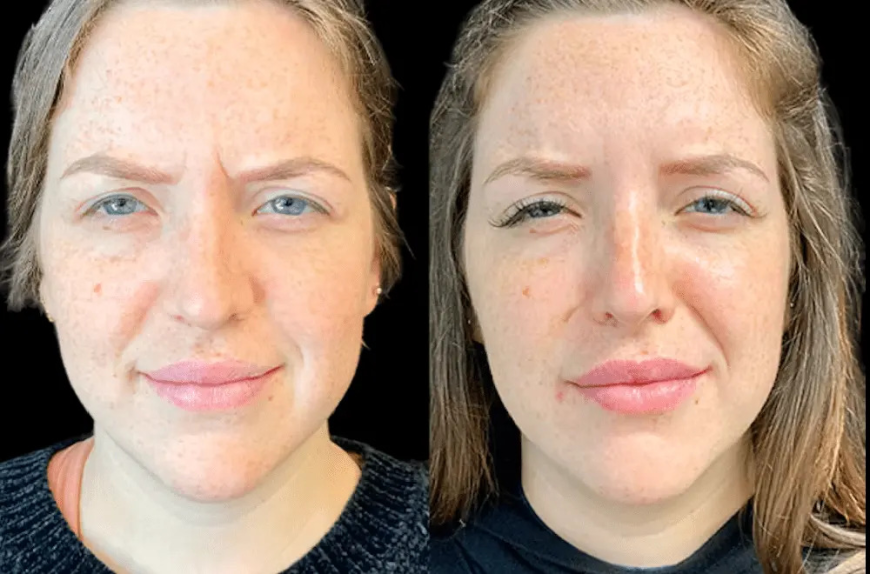 Botox Treatment in Dubai: Botox for Crow’s Feet and Fine Lines