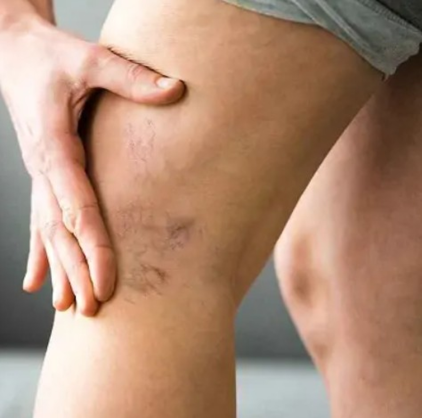 Varicose Veins Treatment In Dubai – Advanced Solutions for Smoother, Healthier-Looking Legs