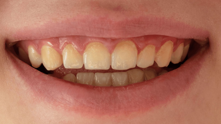 Teeth Whitening in Bryn Mawr | Dillon Family Dentistry
