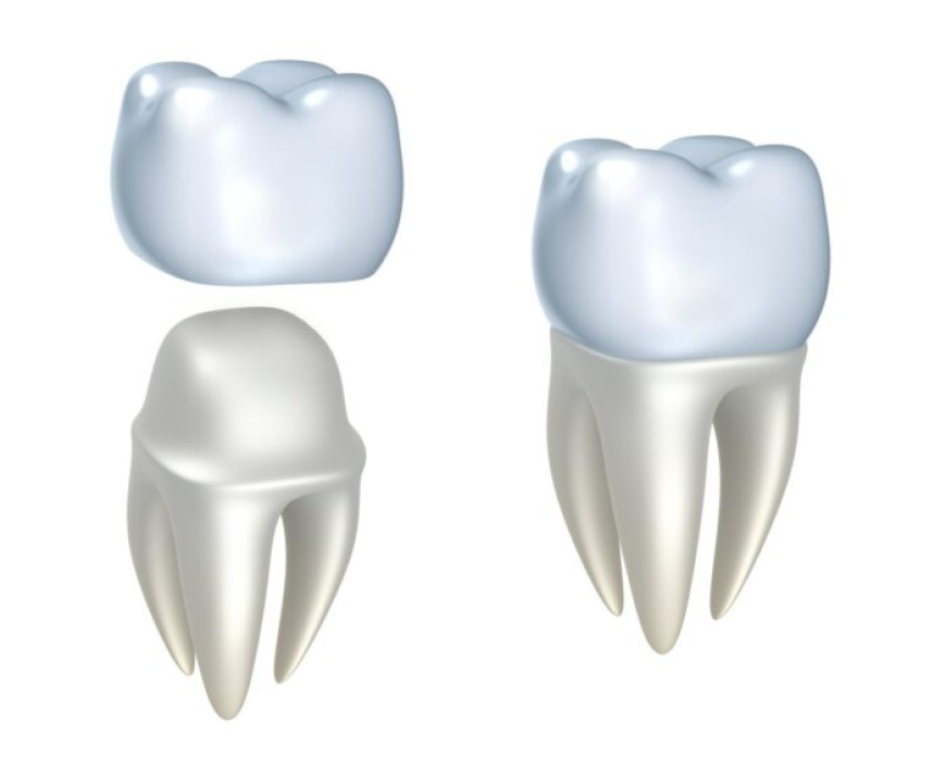Dental Crowns Cost: What You Can Expect to Pay in 2026