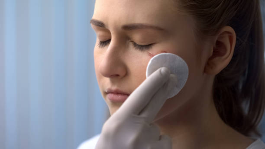 Facial Scar Revision in Dubai | Complete Guide
