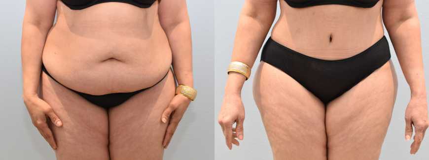 Why Modern Body Sculpting Begins With Understanding Individual Anatomy