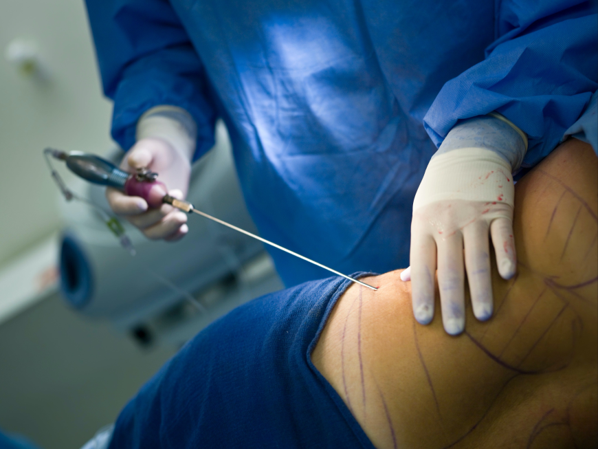 Liposuction for Men What Every Male Patient Should Know
