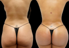 Fat transfer surgery in Dubai: Seasonal Considerations