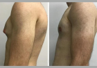 Gynecomastia Surgery in Dubai: The Role of Patient Education in Successful Outcomes