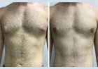 Best Doctors in Dubai Explain the Real Causes of Gynecomastia in Men