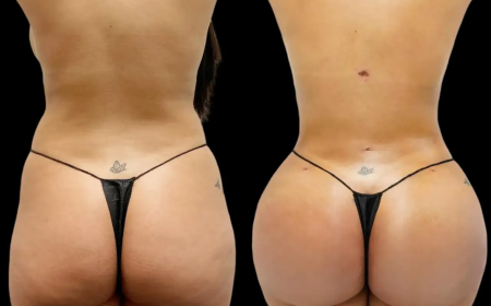 Fat transfer surgery in Dubai: Seasonal Considerations
