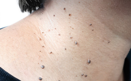 Skin Tag Removal in London: Understanding Modern Removal Methods