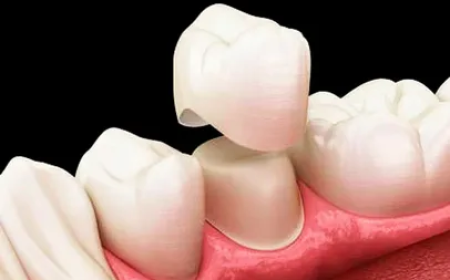 How Can Dental Crowns Treatment in Lahore Restore Teeth?
