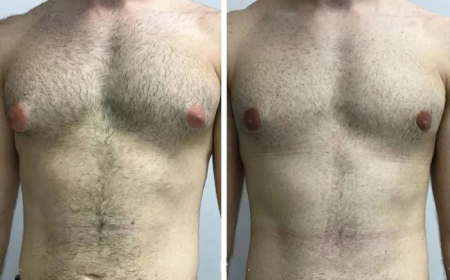 Best Doctors in Dubai Explain the Real Causes of Gynecomastia in Men