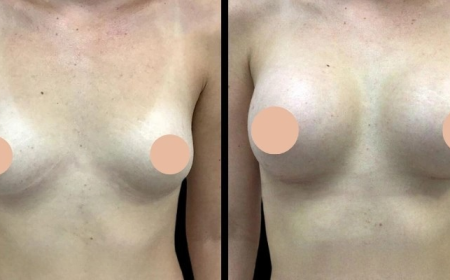 Best Doctors in Dubai Discuss How to Maintain Breast Augmentation Results