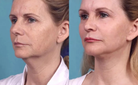 Chemical Peel Treatment for Sun-Exposed Skin with the Best Plastic Surgeon in dubai
