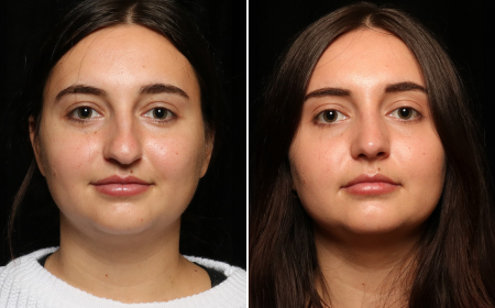 Rhinoplasty in Islamabad: The Personal Profile Blueprint for Contemporary Nose Aesthetics