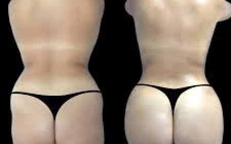 Butt Fat Transfer in Dubai: Exercise After Buttock Fat Grafting