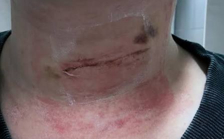How to Protect a Neck Surgery Scar From the Sun