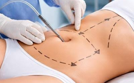 Liposuction Surgery in Dubai: Advanced Body Reshaping with Proven Techniques