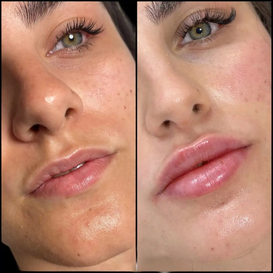 Best Aesthetic Clinic in Dubai for Fillers with Natural-Looking Outcomes