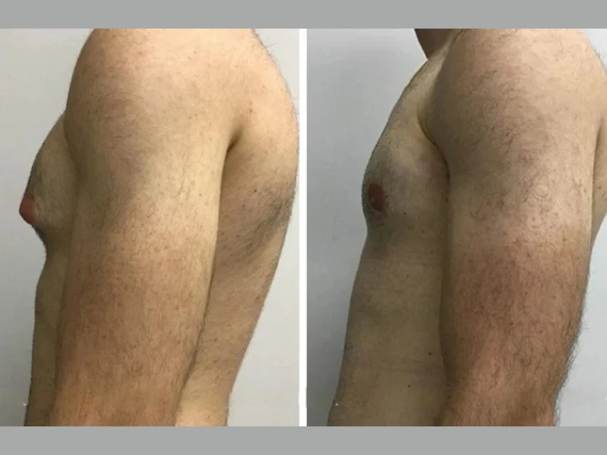 Gynecomastia Surgery in Dubai: The Role of Patient Education in Successful Outcomes