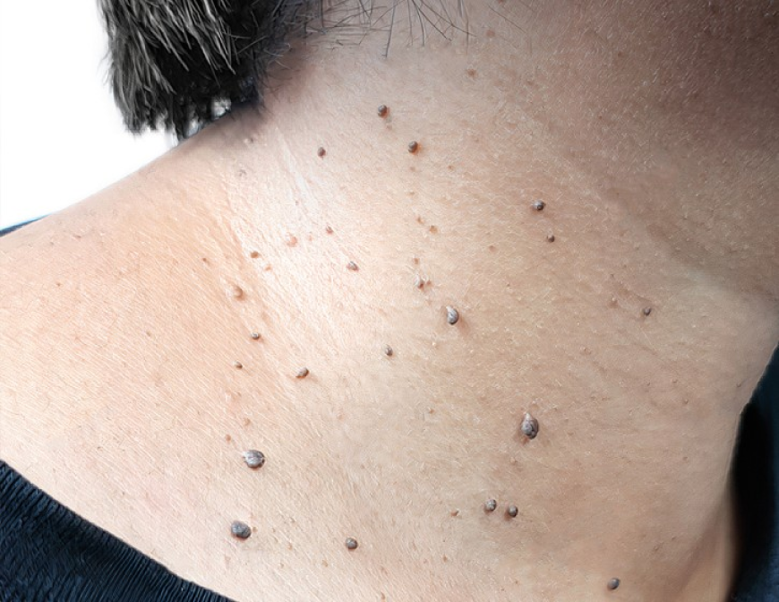 Skin Tag Removal in London: Understanding Modern Removal Methods