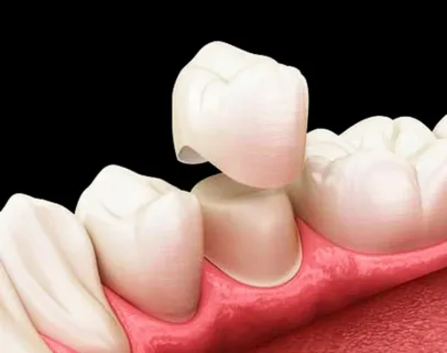 How Can Dental Crowns Treatment in Lahore Restore Teeth?