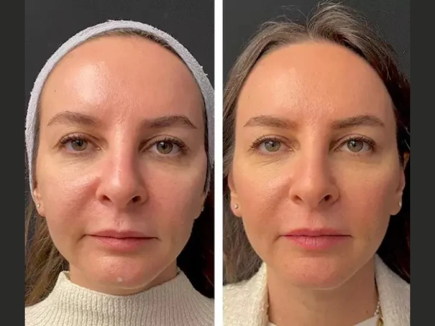 Best Plastic Surgeons in Dubai on Mesotherapy for Dark Circles and Under-Eye Rejuvenation