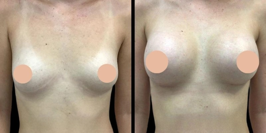 Best Doctors in Dubai Discuss How to Maintain Breast Augmentation Results