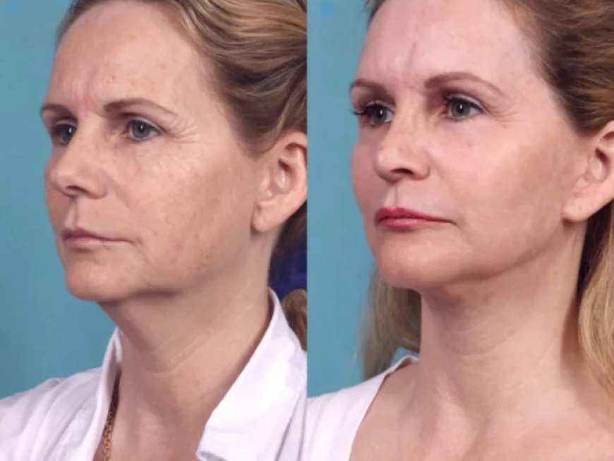 Chemical Peel Treatment for Sun-Exposed Skin with the Best Plastic Surgeon in dubai