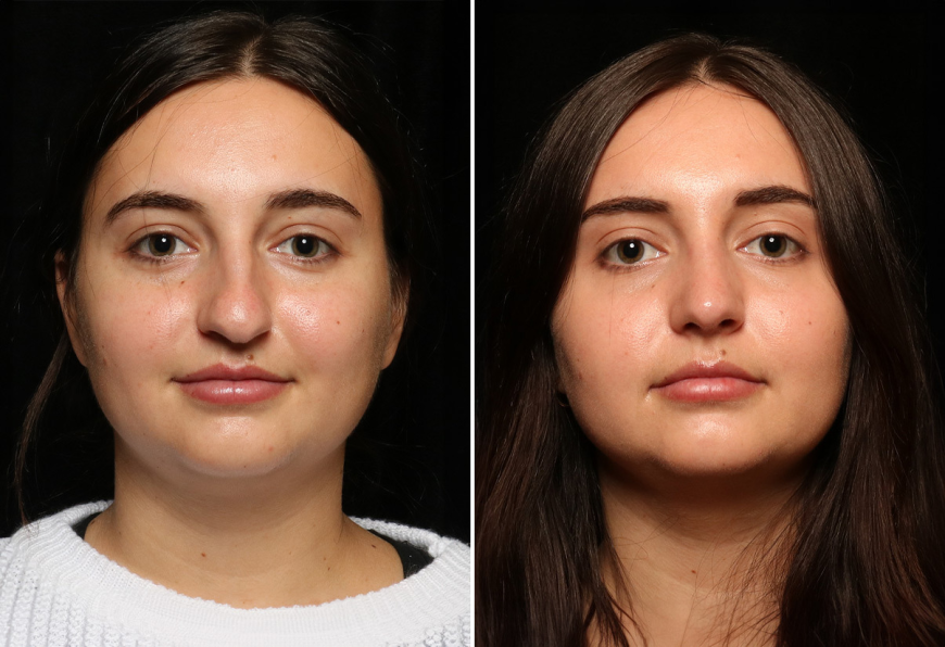 Rhinoplasty in Islamabad: The Personal Profile Blueprint for Contemporary Nose Aesthetics
