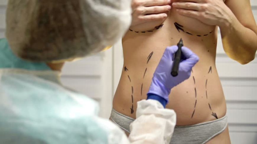 Liposuction in Islamabad: Beyond Measurements, Discovering the Philosophy of Body Sculpting