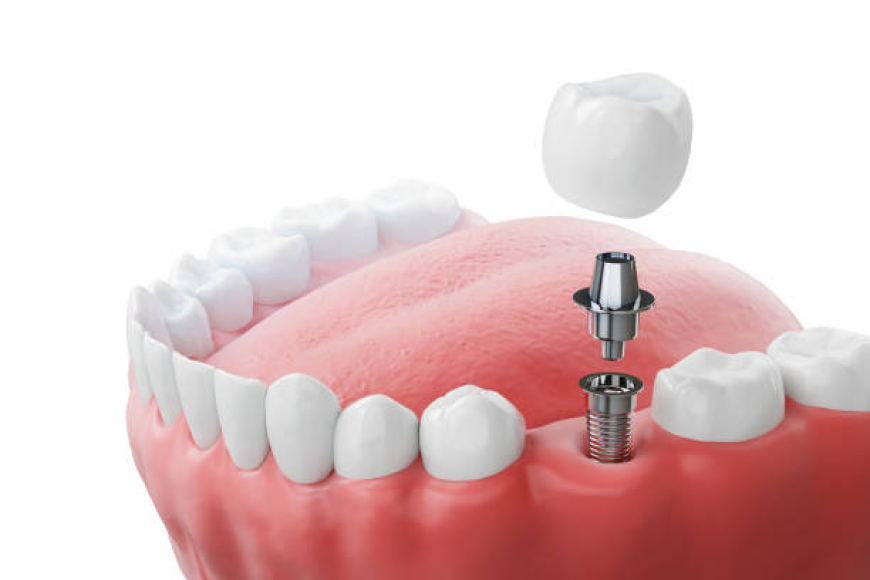 Dental Implants vs. Other Tooth Replacement Options