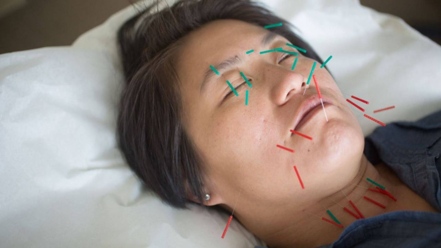 Facial Rejuvenation Acupuncture Before an Event: Timeline