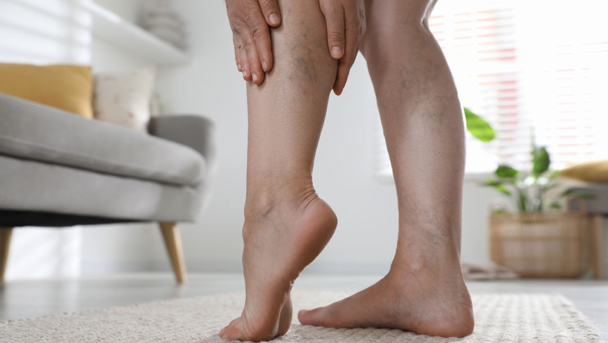 Spider Veins In Manchester: Modern Vein Care for Smoother-Looking Legs
