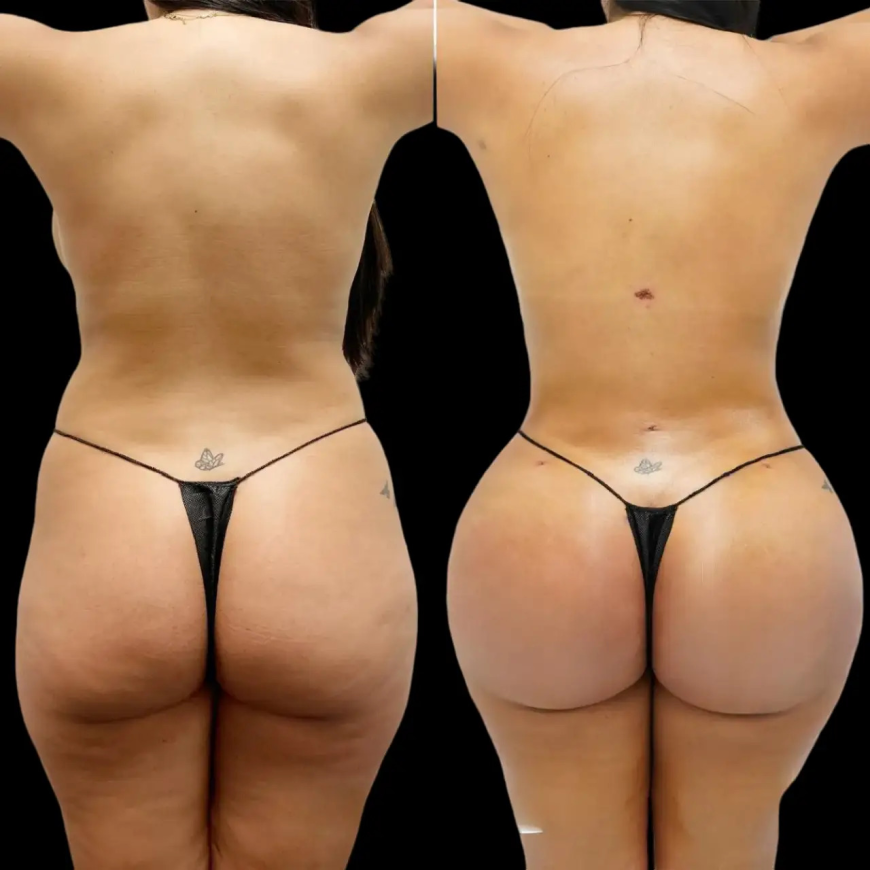 Fat Transfer in Dubai: Signs of Normal Recovery Versus Warning Signs