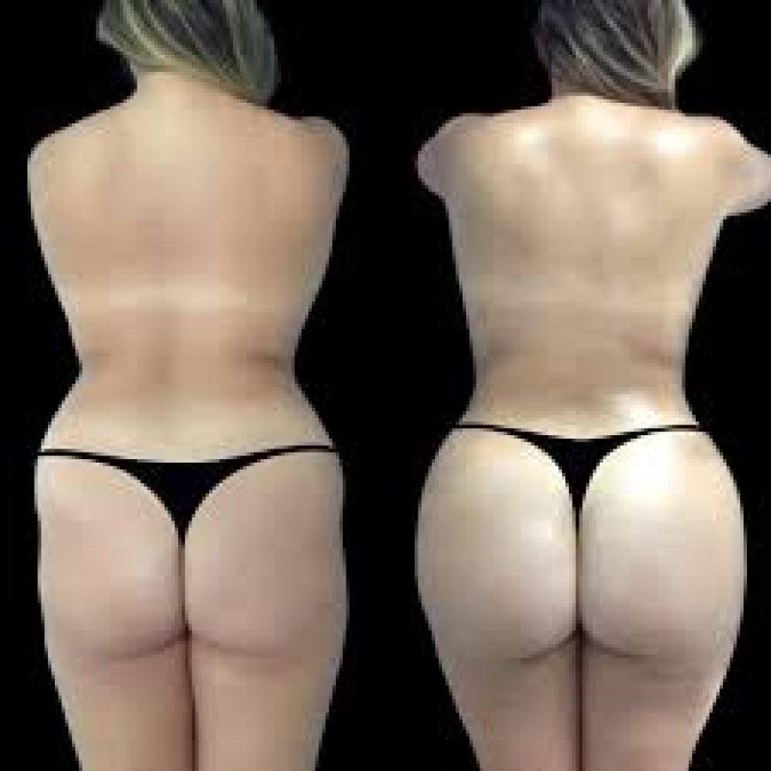 Butt Fat Transfer in Dubai: Exercise After Buttock Fat Grafting