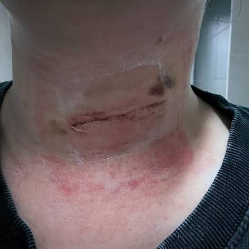 How to Protect a Neck Surgery Scar From the Sun