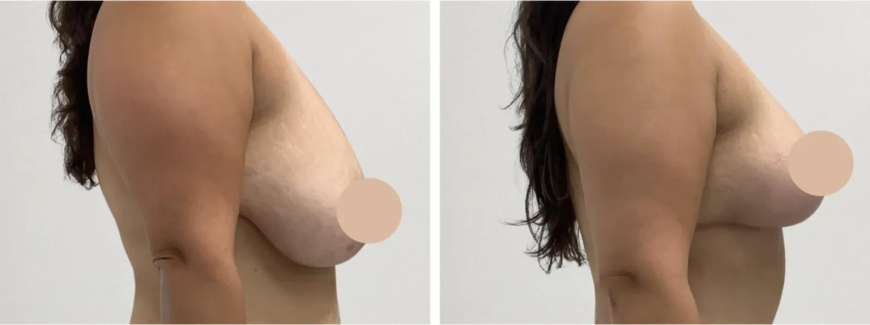 Best Breast Lift Surgeon in Dubai for Stunning Aesthetic Outcomes