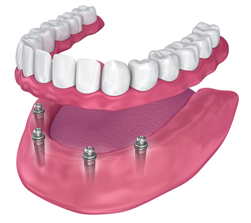How to Compare Dental Family Insurance Plans for Your Needs