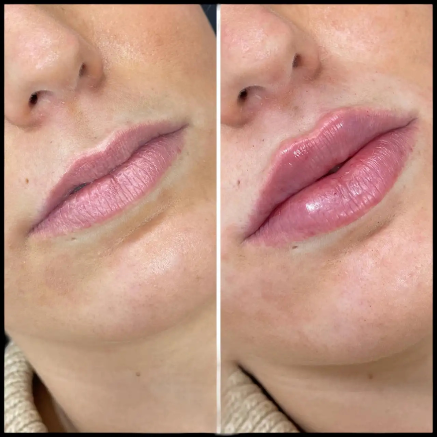 Dermal Fillers Treatment in Dubai for Smooth Wrinkle Reduction