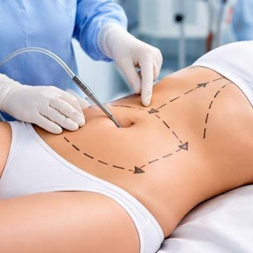 Liposuction Surgery in Dubai: Advanced Body Reshaping with Proven Techniques